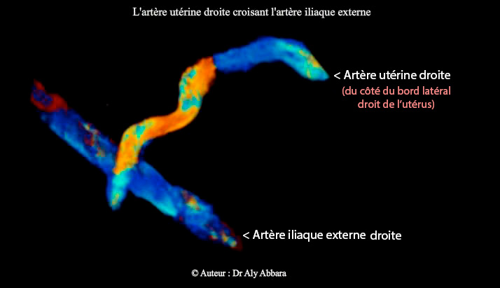 artère utérine droite croisant l'artère iliaque externe droite