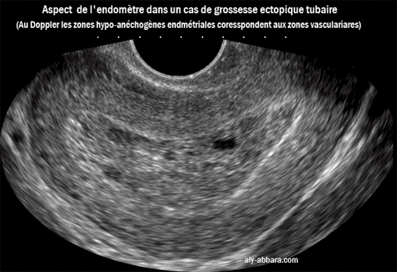 Endomètre épais, de 30 mm associé à une grossesse extra-utérine tubaire gauche