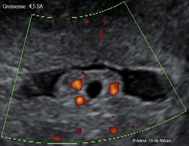 Grossesse intra-utérine de 4,5 SA