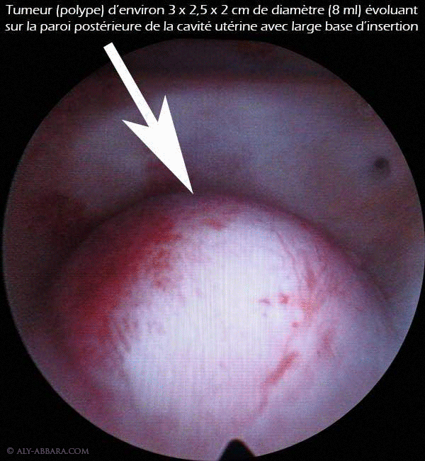 Polype endométrial par hyperplasie gladulo-kystique bénigne