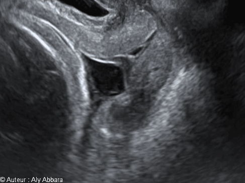 La poche des eaux agissant sur la col utérin sous l'effet des contractions utérines - échocardiographie