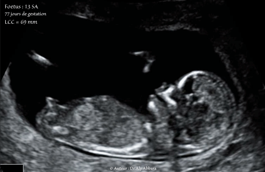 Foetus Age De 13 Sa 77 Jours De Gestation Anatomie Et Motricite جنين بعمر 77 يوما العناصر التشريحية الجنينية
