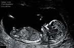 Foetus de 13 SA - ouverture et fermeture de la bouche