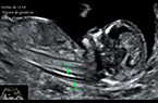 Foetus de 13 SA - flexion et déflexion de la tête