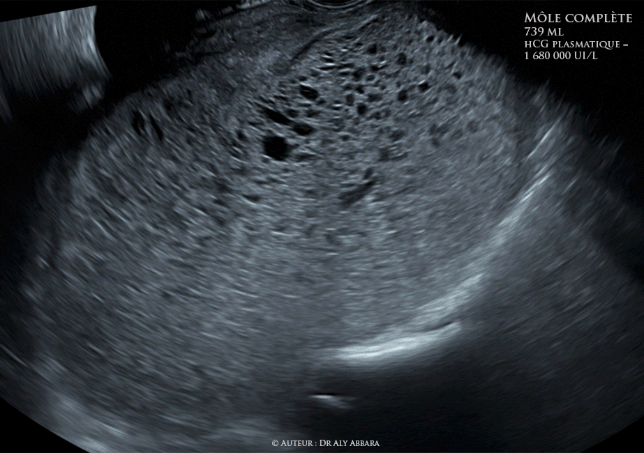 Grossesse môlaire (môle complète) de 739 ml de volume - Aspect échographique et clinique - الحمل العداري أو الرحى العدارية