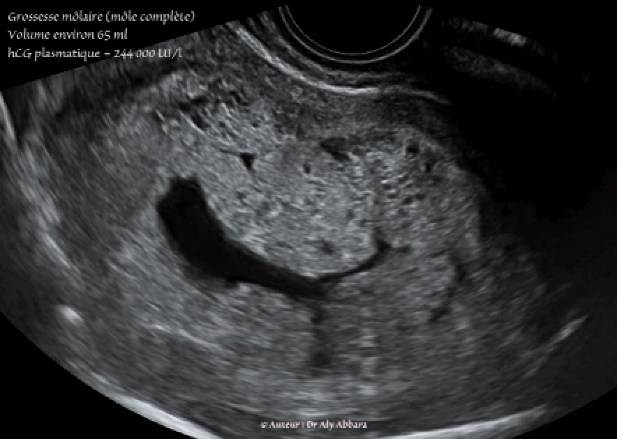 Grossesse môlaire (môle complète) - Aspect échographique - الحمل العداري أو الرحى العدارية