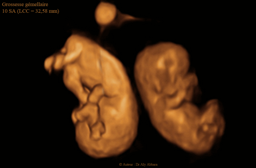 Vrais jumeaux dansant - 10 SA - توأمان حقيقيان بسن 10 أسابيع