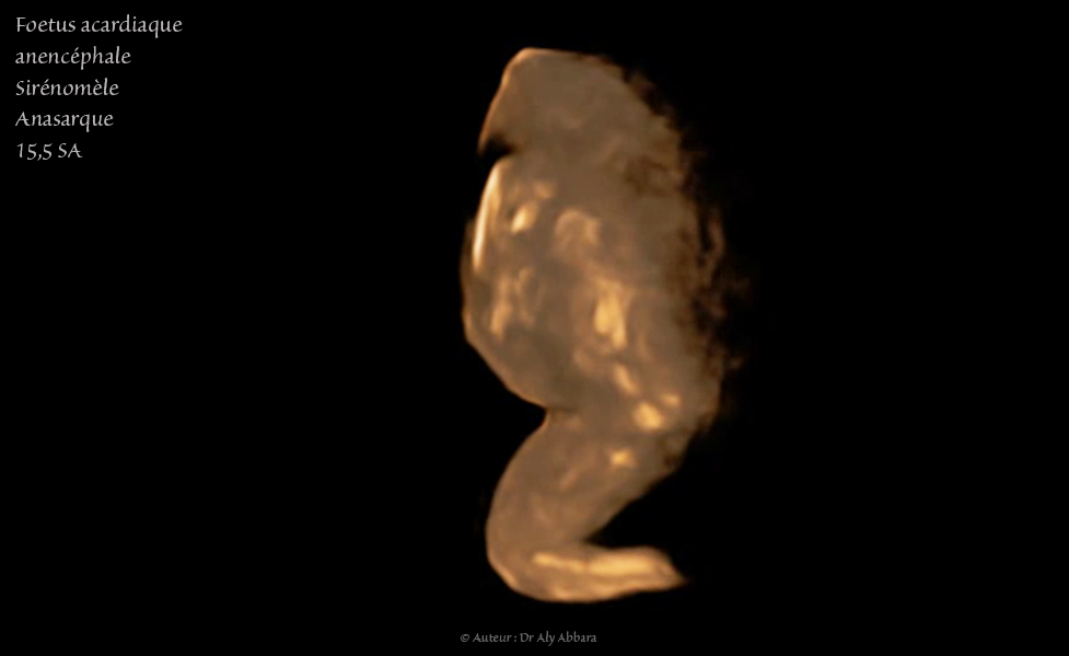 DIU au cuivre : déplacemet vers le canal endocervical sous l'effect des contractions utérines