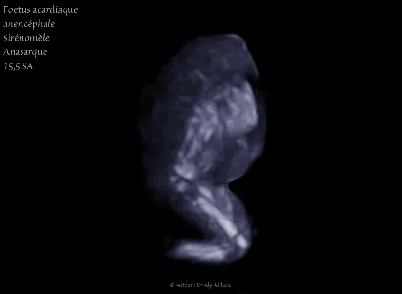 DIU au cuivre : déplacemet vers le canal endocervical sous l'effect des contractions utérines