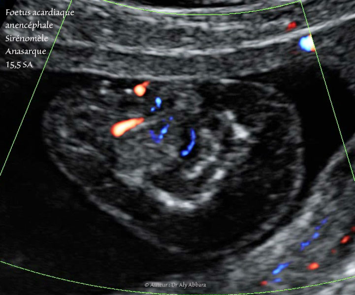 DIU au cuivre : déplacemet vers le canal endocervical sous l'effect des contractions utérines