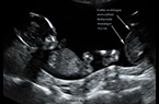 Jumeau acardiaque - grossesse gémellaire monochoriale biamniotique