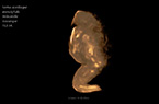 Jumeau acardiaque - grossesse gémellaire monochoriale biamniotique - acranie - amélie supérieure - sirénomélie - oedème généralisé - couleur sépia - rotation axiale