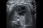 Mouvements respiratoires foetaux - coupe axiale sur le thorax foetal