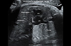 Mouvements respiratoires foetaux - coupe sagittale sur le tronc foetal