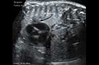 Hoquet chez le foetus - coupe longitudinale du tronc foetal