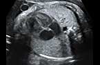 Hoquet chez le foetus - coupe longitudinale du tronc foetal