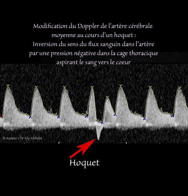 L'analyse spectrale du Doppler de la circulation artérielle foetale montrant que l'hoquet se manifeste par une brusque onde négative due à une inversion du flux sanguin artériel