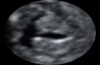 La motricité des cordes vocales du larynx foetal au cours des mouvements respiratoires in utero