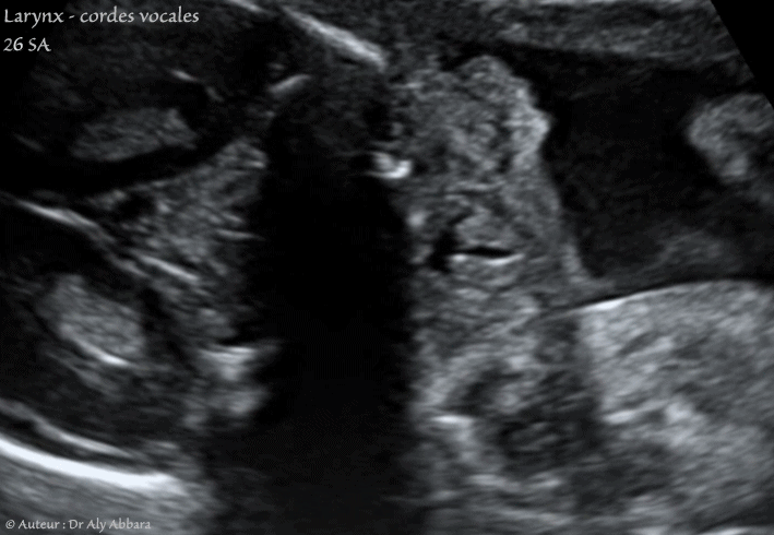 Ejection-aspiration nasales du liquide amniotique au cours des mouvements respiratoires foetaux - إدخال وإخراج السائل الأمنيوسي عبر الأنف