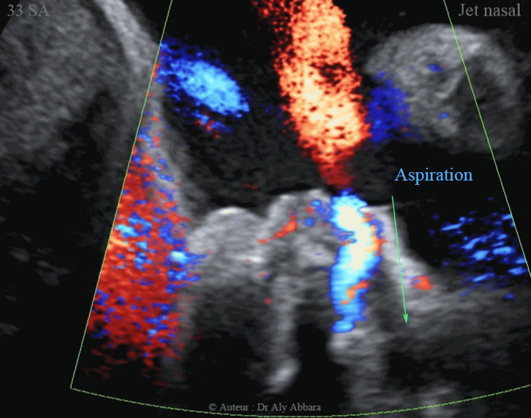 Ejection-aspiration nasales du liquide amniotique au cours des mouvements respiratoires foetaux - إدخال وإخراج السائل الأمنيوسي عبر الأنف