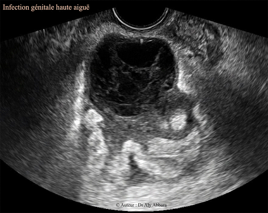 Salpingite aiguë et péritonite pelvienne - Echographie