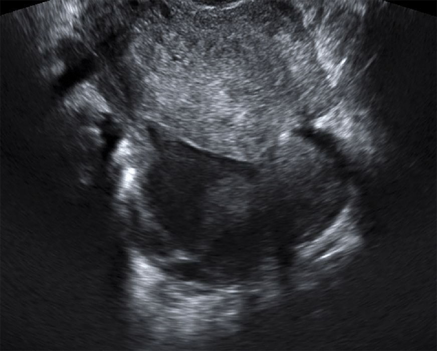 Abcès pelvien - Infection génitale haute aiguë - Echographie