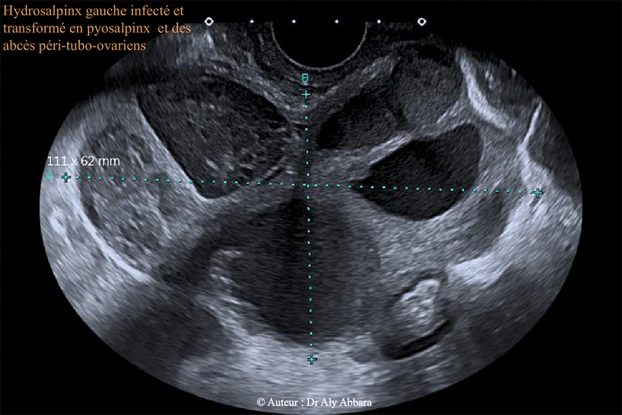 Hydrosalpinx abcédé - Infection génitale haute aiguë - échographie