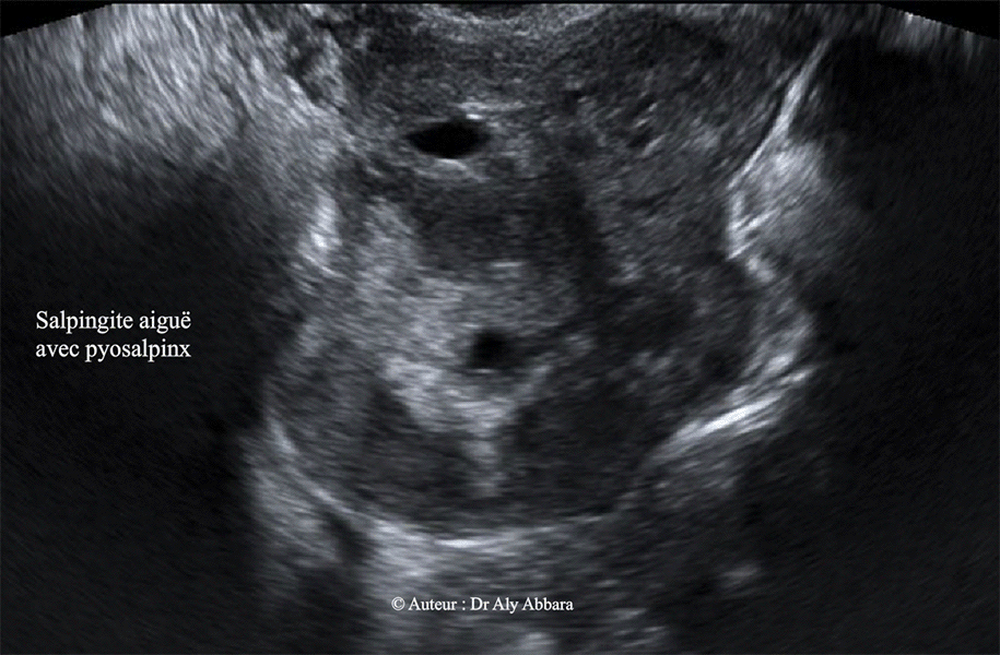 Salpingite aiguë au stade de pyosalpinx - Echographie