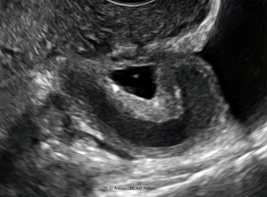 Salpingite chronique - Hydrosalpinx - Echographie