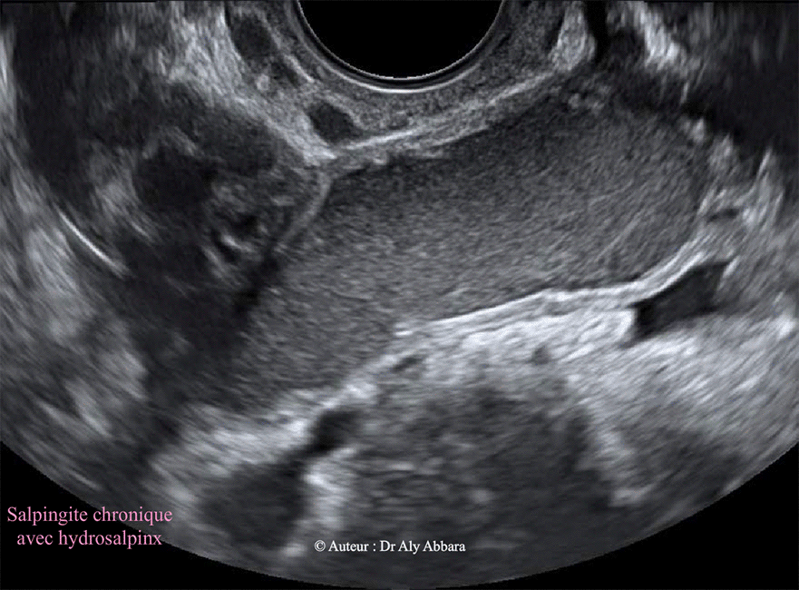 Salpingite chronique - Hydrosalpinx - Echographie