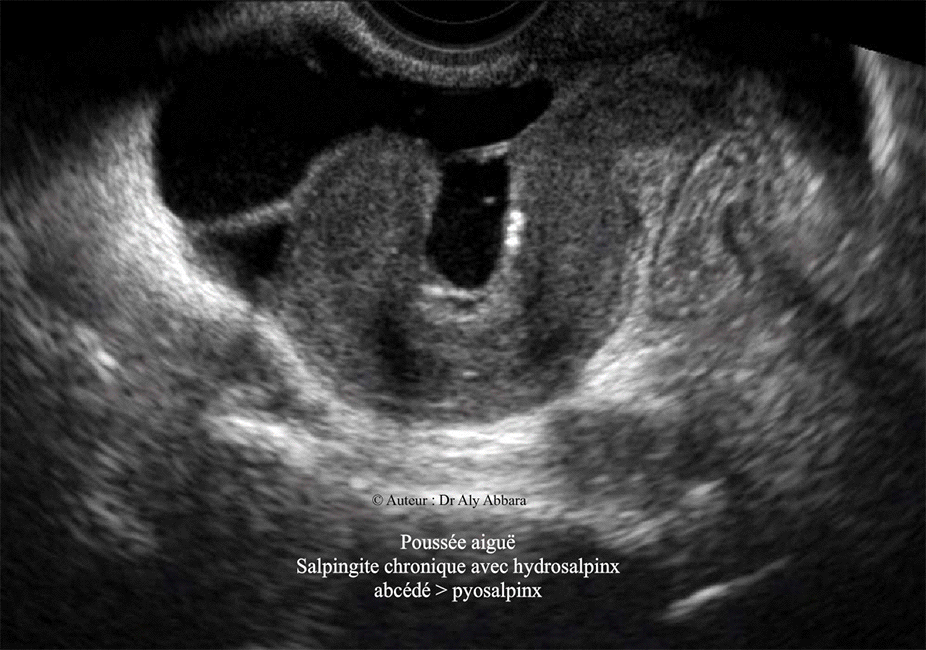 Salpingite chronique avec hydrosalpinx abcédé - Echographie