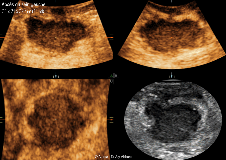 Abcès du sein gauche - خُراج الثدي الأيسر