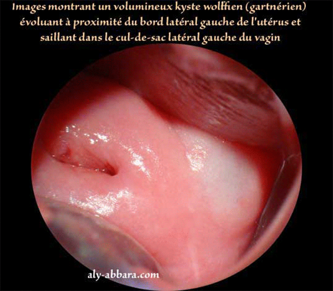 Kyste Wolffien para-utéro-vaginal-gauche - images cliniques