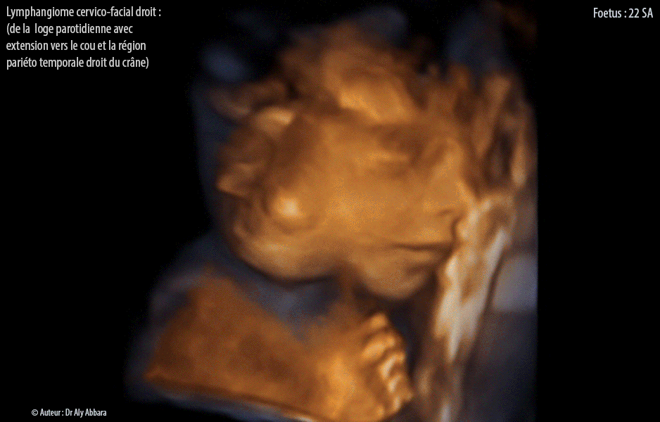 Lymphangiome micro et macrokystique cervico-facial droit - Grossesse de 22 SA - Images échographiques en 2D et 3D