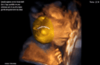 Lymphangiome micro et macrokystique cervico-facial droit - Grossesse de 22 SA - Images échographiques en 2D et 3D