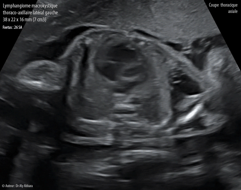 Lymphangiome macrokystique thoraco-axillaire gauche - Grossesse de 26 SA - Images échographiques en 2D