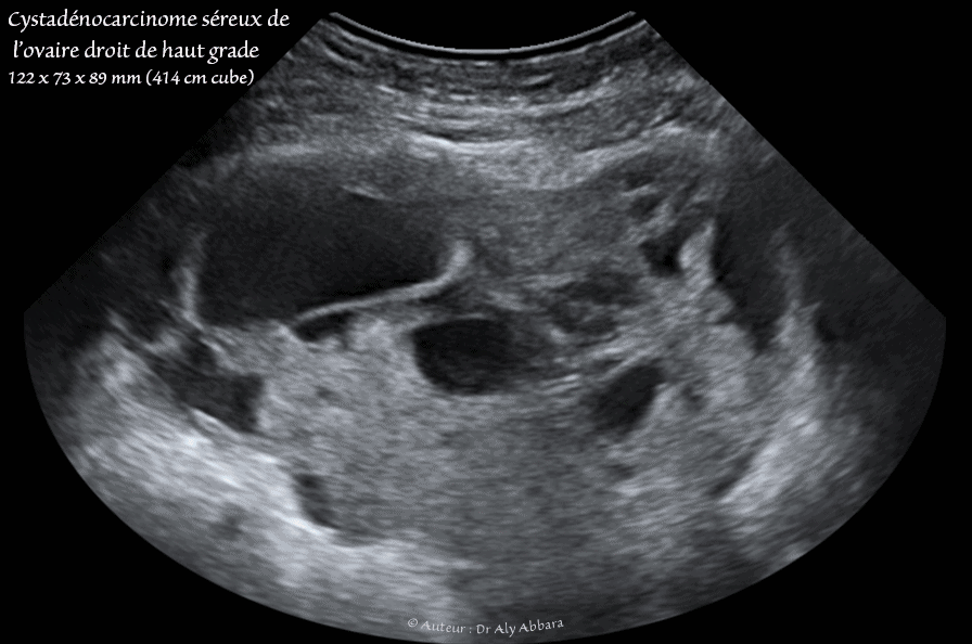 Annexes utérines droites - cystadénocarcinome séreux de haut grade de l'ovaire envahissant la trompe - images échographiques