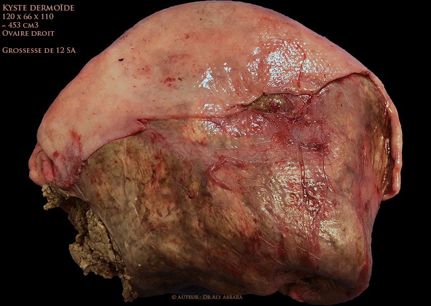 Ovaire droit - Volumineux tératome bénin(kyste dermoïde) chez une femme enceinte de 12 SA - Images cliniques