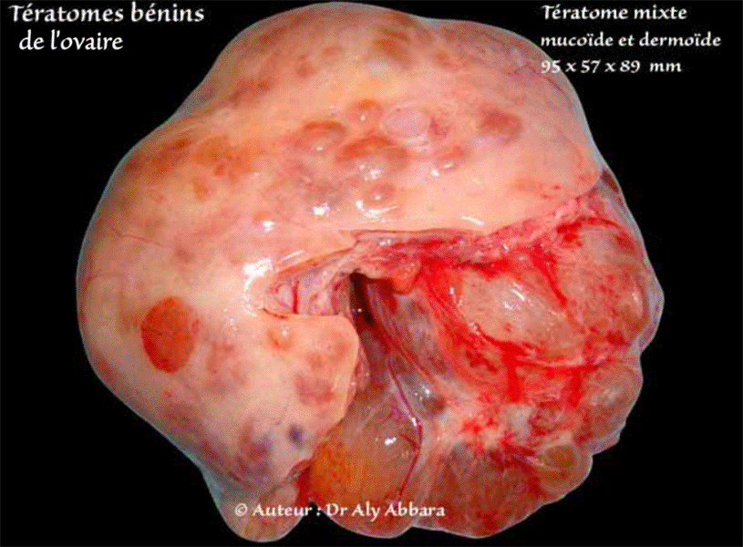 Kyste ovarien mixte, mucineux et dermoïde - Images cliniques