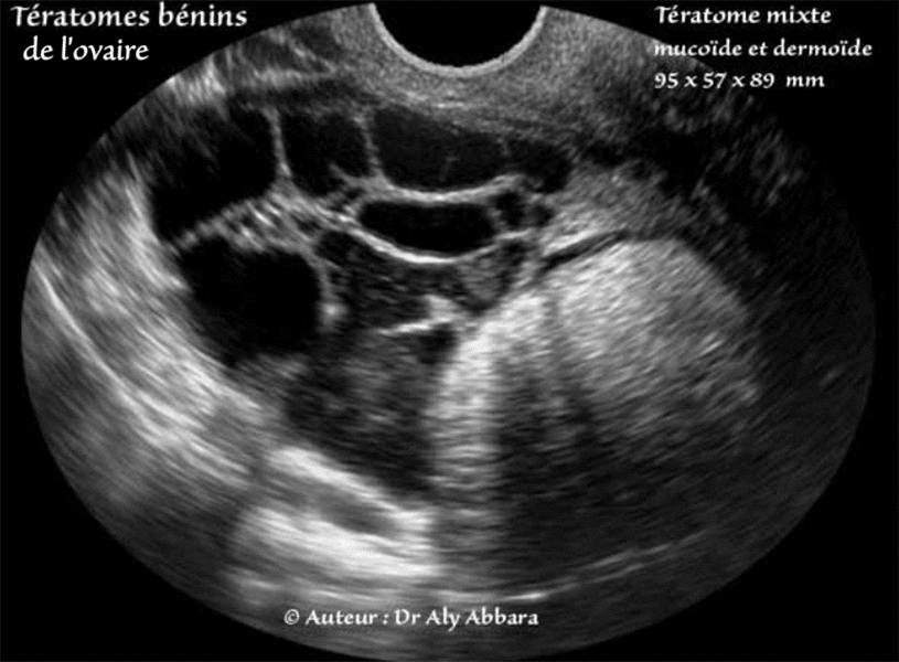 Kyste ovarien mixte, mucineux et dermoïde - Images échographiques