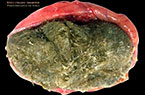 Ovaires : tératomes matures bénins ou kystes dermoïdes - Images cliniques -autodiaporama