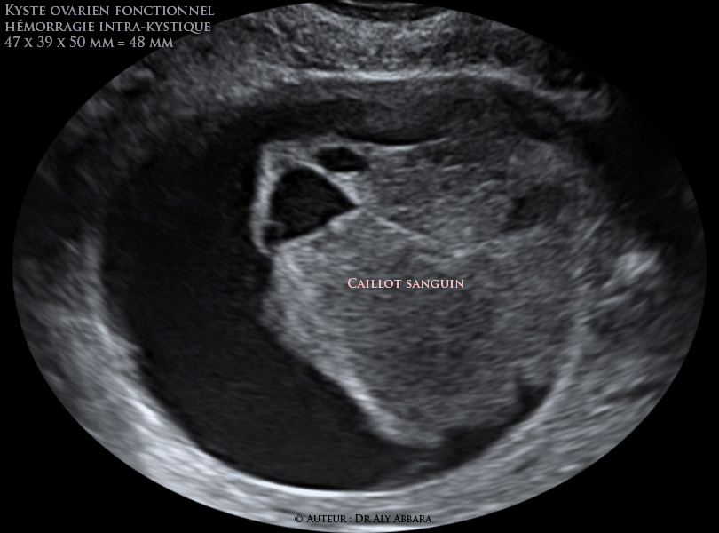 Kyste ovarien fonctionnel : hémorragie intrakystique prenant l'aspect échographique d'une composante solide évoluant dans la cavité kystique