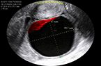 Kyste fonctionnel de l'ovaire gauche : régression spontanée confirmée par contrôle échographique trois mois plus tard