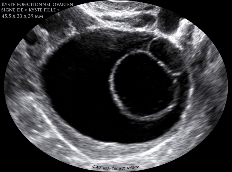 Kyste ovarien fonctionnel Signe de kyste fille -(Daughter cyst sign)