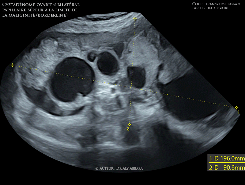 Ovaires - Cystadénome ovarien bilatéral papillaire séreux à la limite de la maliginité (borderline) - Échographie