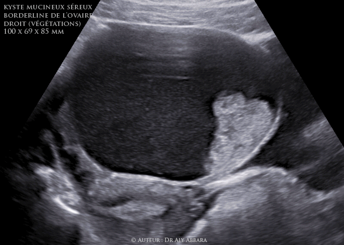 Ovaire droit - cystadénome ovarien droit séro-mucineux  à la limite de la malignité (borderline) - Échographie