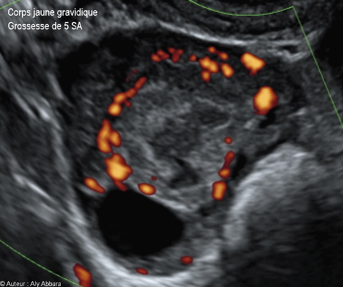 Corps jaune gravidique dans l'ovaire droit - Doppler Energie - جسم أصفر حملي في المبيض الأيمن
