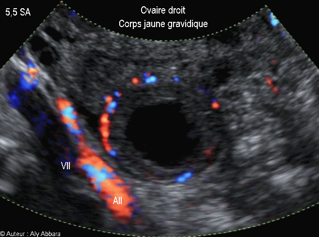 Corps jaune gravidique dans l'ovaire droit - جسم أصفر حملي في المبيض الأيمن -  5,5 SA