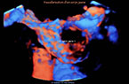 Vascularisation du corps jaune analysée par Doppler mode Dynamic Flow, en 3D