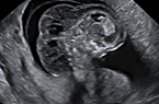 Séquence du cordon ombilical court, Body stalk anomaly - BSA - Régression caudale - Lymphangiom - Foetus de 25 SA - Signes échographiques